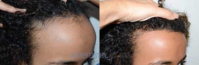Before & After Hairline Lowering / Forehead Reduction Case 273 View 3 View in Miami, FL