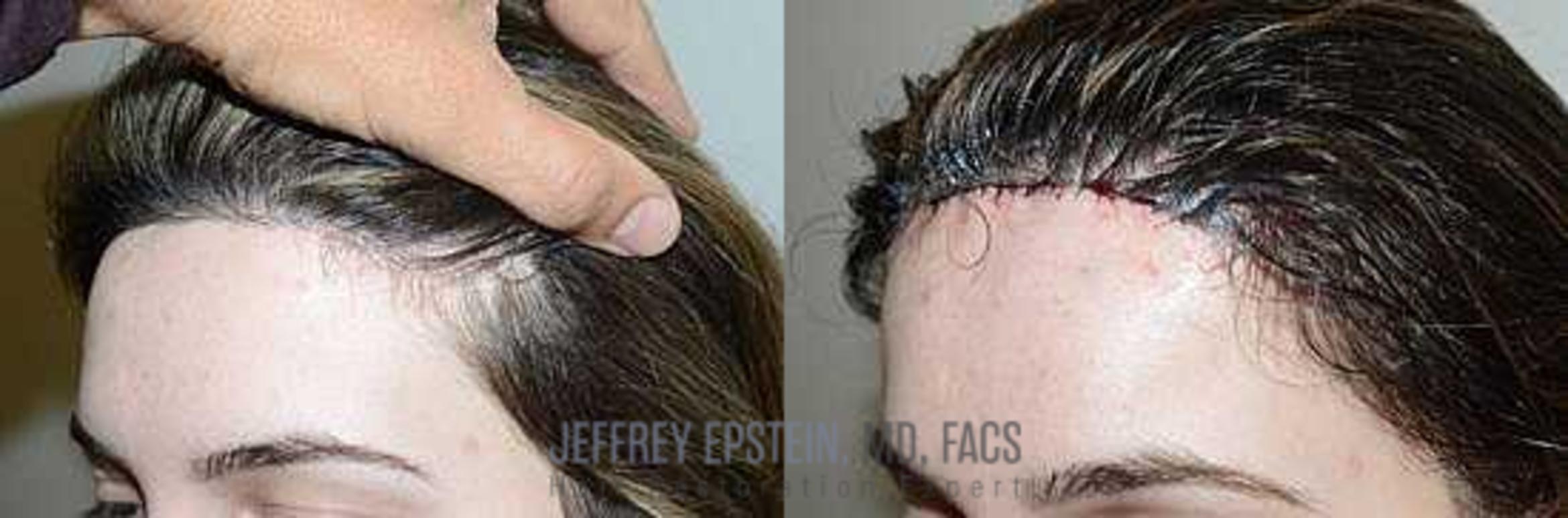 Before & After Hairline Lowering / Forehead Reduction Case 274 View 1 View in Miami, FL