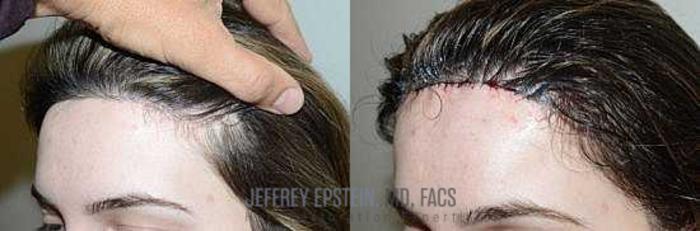 Before & After Hairline Lowering / Forehead Reduction Case 274 View 1 View in Miami, FL