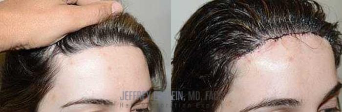 Before & After Hairline Lowering / Forehead Reduction Case 274 View 2 View in Miami, FL