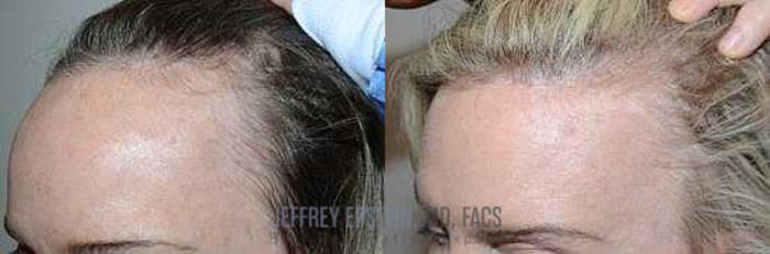 Before & After Hairline Lowering / Forehead Reduction Case 275 View 1 View in Miami, FL