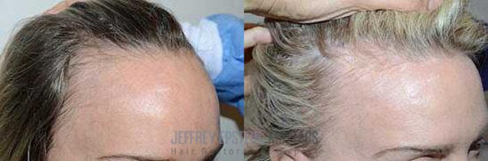Before & After Hairline Lowering / Forehead Reduction Case 275 View 3 View in Miami, FL
