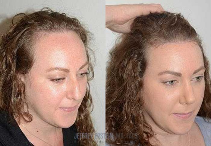 Before & After Hairline Lowering / Forehead Reduction Case 276 View 1 View in Miami, FL