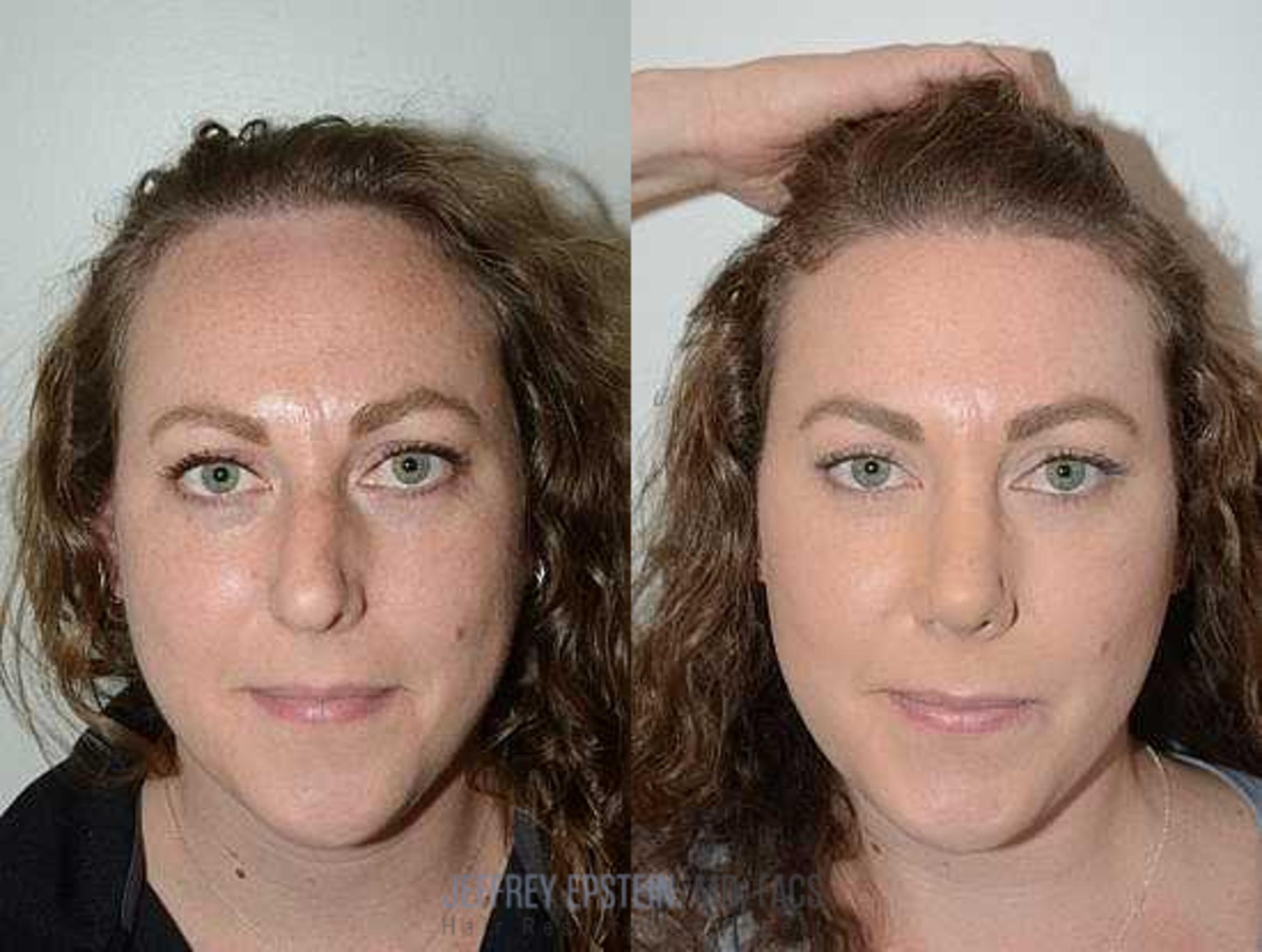Before & After Hairline Lowering / Forehead Reduction Case 276 View 2 View in Miami, FL