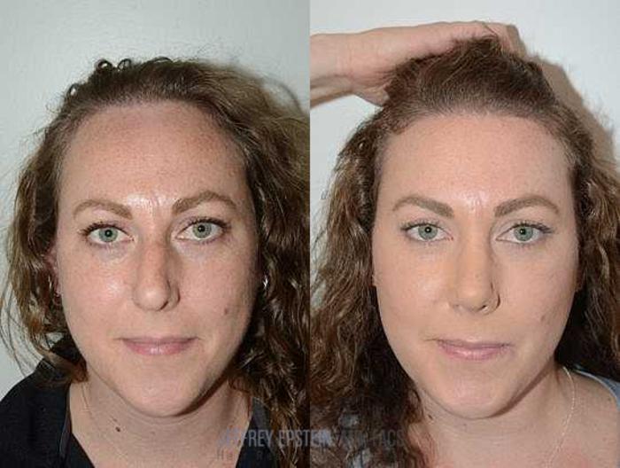 Before & After Hairline Lowering / Forehead Reduction Case 276 View 2 View in Miami, FL
