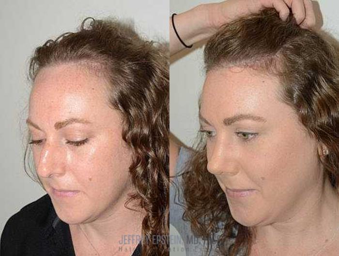 Before & After Hairline Lowering / Forehead Reduction Case 276 View 3 View in Miami, FL