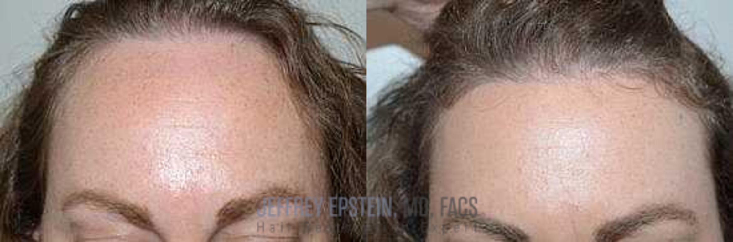 Before & After Hairline Lowering / Forehead Reduction Case 276 View 4 View in Miami, FL