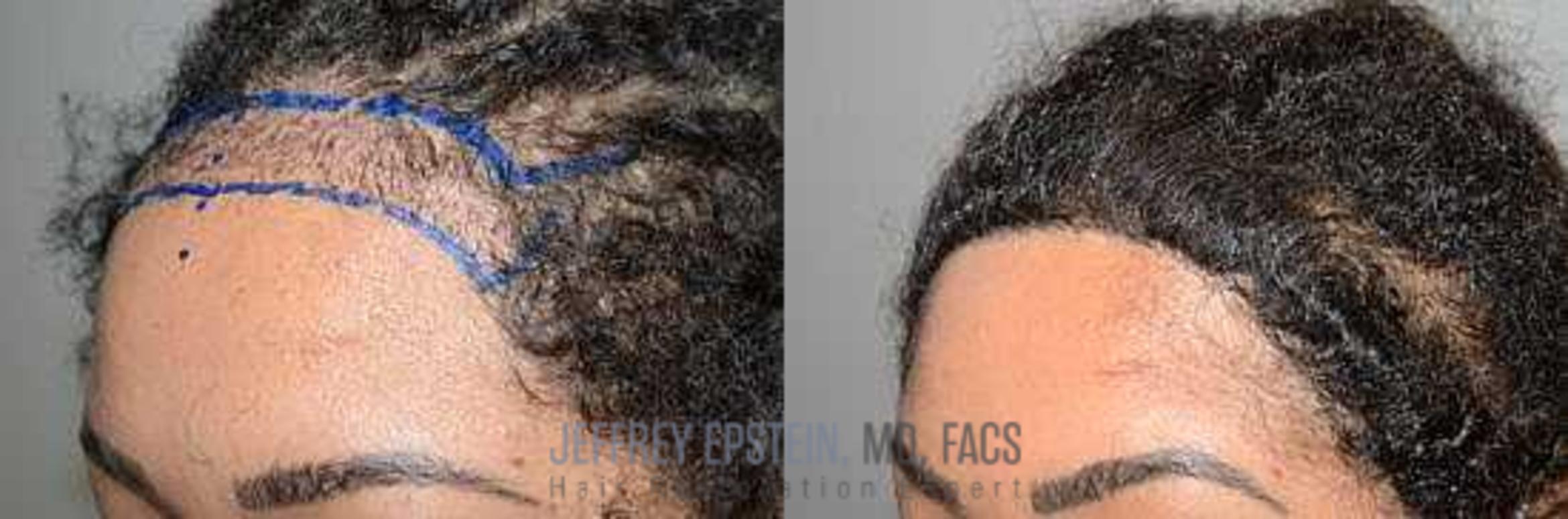 Before & After Hairline Lowering / Forehead Reduction Case 277 View 1 View in Miami, FL