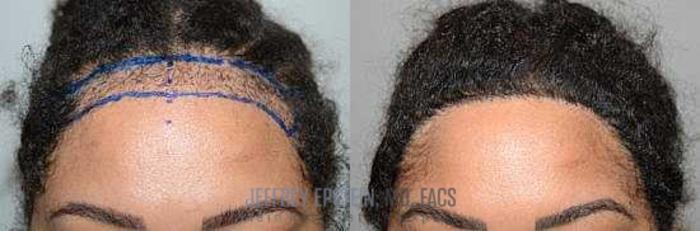Before & After Hairline Lowering / Forehead Reduction Case 277 View 2 View in Miami, FL