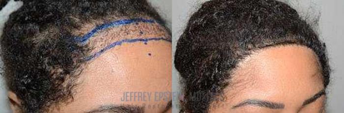 Before & After Hairline Lowering / Forehead Reduction Case 277 View 3 View in Miami, FL
