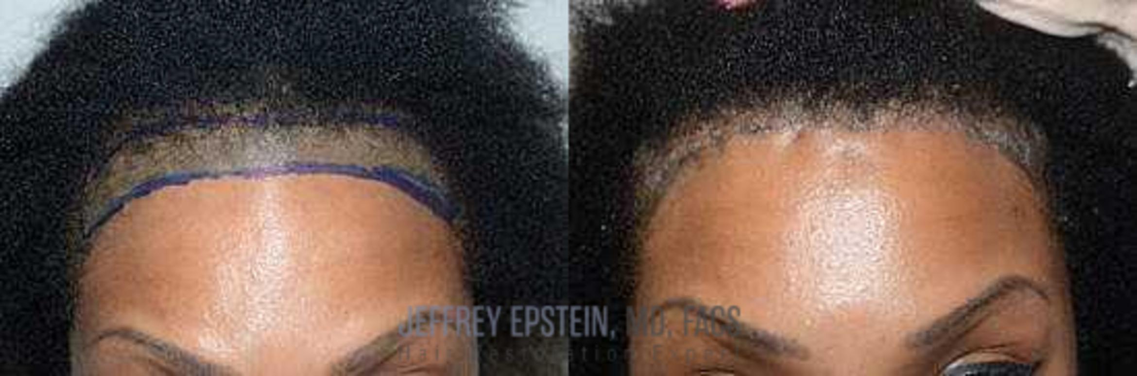 Before & After Hairline Lowering / Forehead Reduction Case 278 View 2 View in Miami, FL