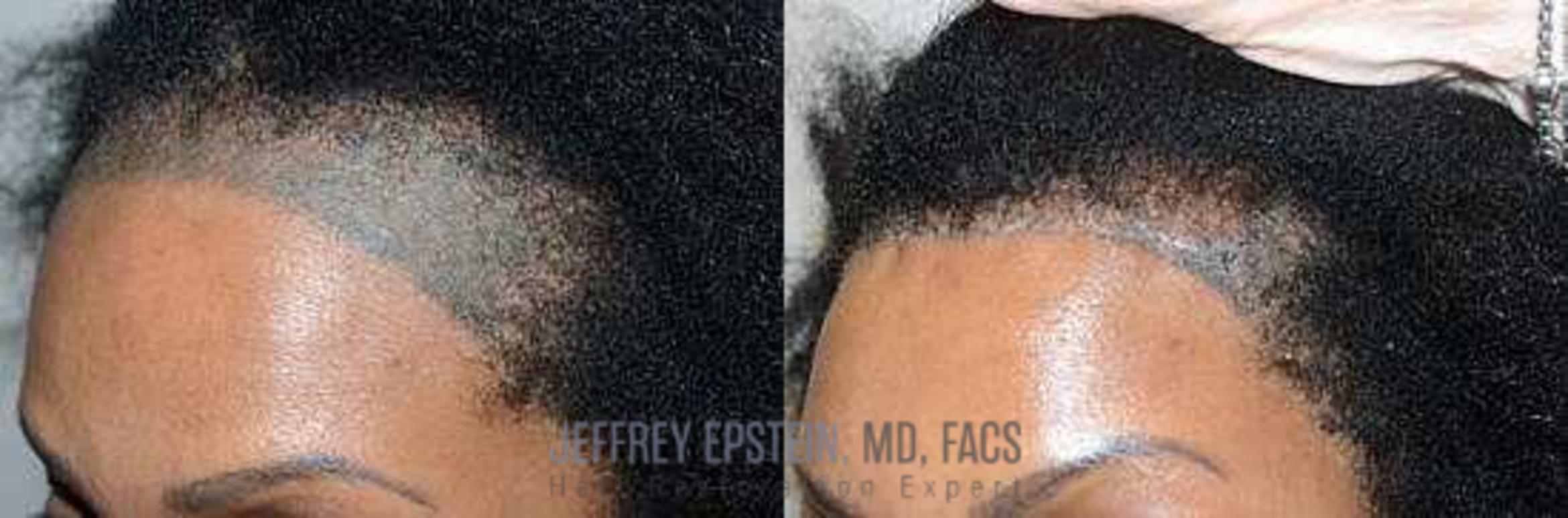 Before & After Hairline Lowering / Forehead Reduction Case 278 View 3 View in Miami, FL