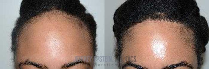 Before & After Hairline Lowering / Forehead Reduction Case 279 View 1 View in Miami, FL