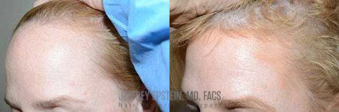 Before & After Hairline Lowering / Forehead Reduction Case 280 View 1 View in Miami, FL