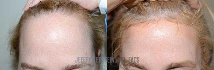 Before & After Hairline Lowering / Forehead Reduction Case 280 View 2 View in Miami, FL