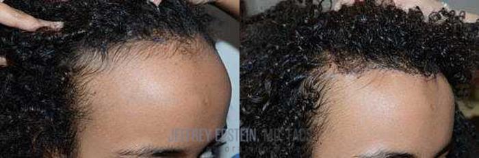 Before & After Hairline Lowering / Forehead Reduction Case 282 View 1 View in Miami, FL