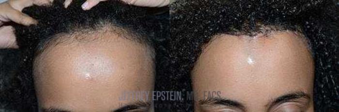 Before & After Hairline Lowering / Forehead Reduction Case 282 View 3 View in Miami, FL