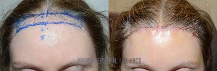 Before & After Hairline Lowering / Forehead Reduction Case 283 View 1 View in Miami, FL