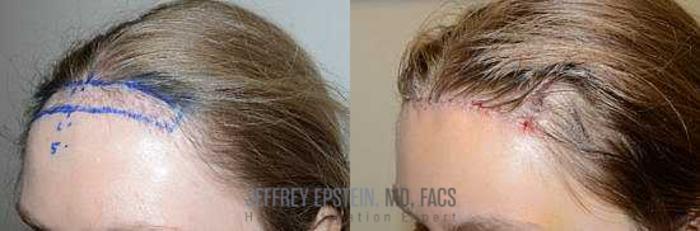 Before & After Hairline Lowering / Forehead Reduction Case 283 View 2 View in Miami, FL
