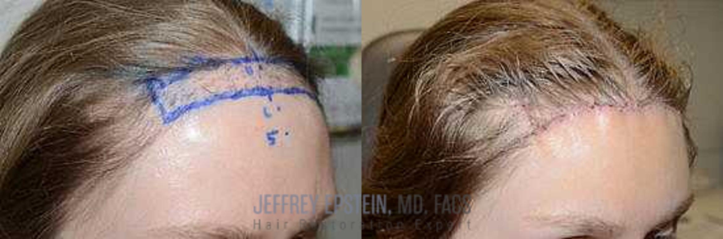 Before & After Hairline Lowering / Forehead Reduction Case 283 View 3 View in Miami, FL