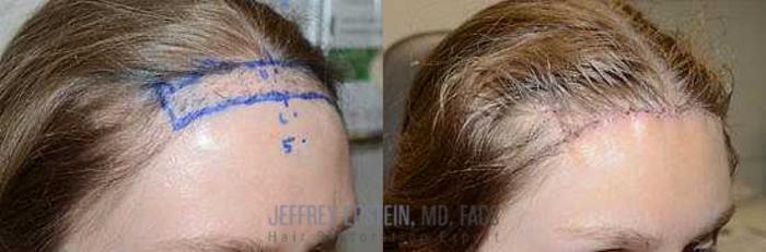 Before & After Hairline Lowering / Forehead Reduction Case 283 View 3 View in Miami, FL