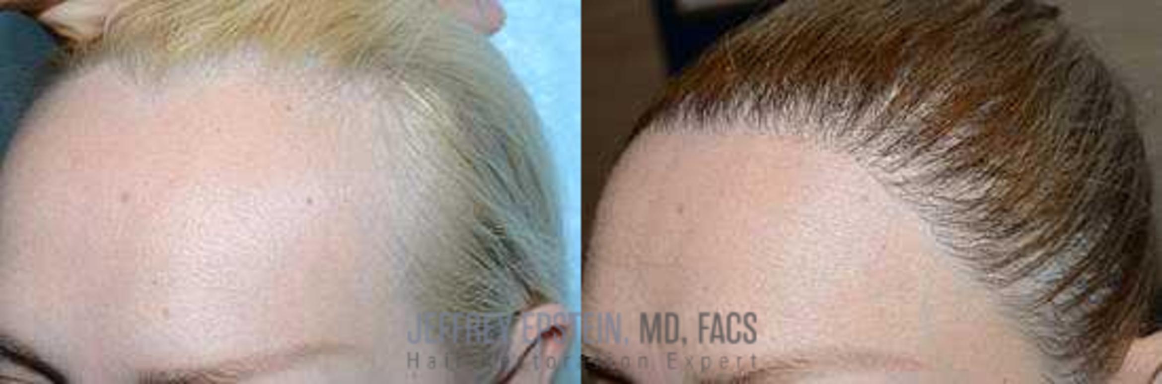 Before & After Hairline Lowering / Forehead Reduction Case 285 View 1 View in Miami, FL