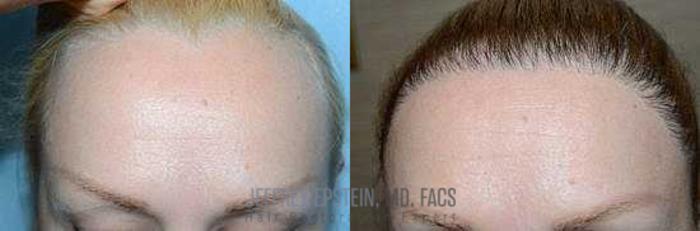 Before & After Hairline Lowering / Forehead Reduction Case 285 View 2 View in Miami, FL