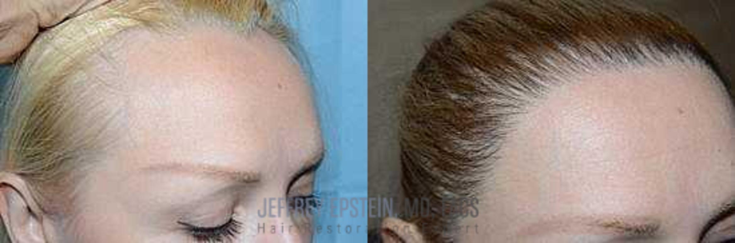 Before & After Hairline Lowering / Forehead Reduction Case 285 View 3 View in Miami, FL