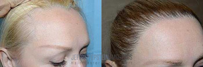 Before & After Hairline Lowering / Forehead Reduction Case 285 View 3 View in Miami, FL