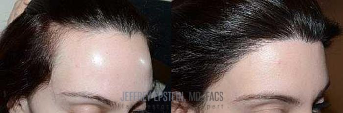 Before & After Hairline Lowering / Forehead Reduction Case 286 View 1 View in Miami, FL