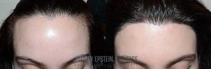 Before & After Hairline Lowering / Forehead Reduction Case 286 View 2 View in Miami, FL