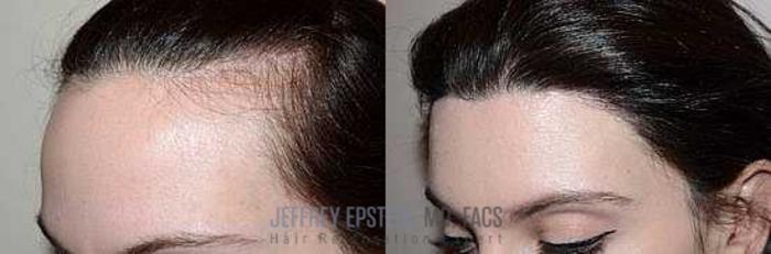 Before & After Hairline Lowering / Forehead Reduction Case 286 View 3 View in Miami, FL