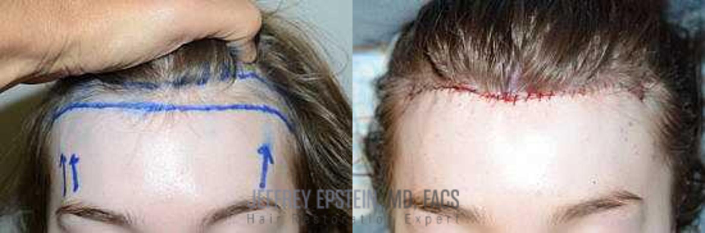 Before & After Hairline Lowering / Forehead Reduction Case 287 View 1 View in Miami, FL