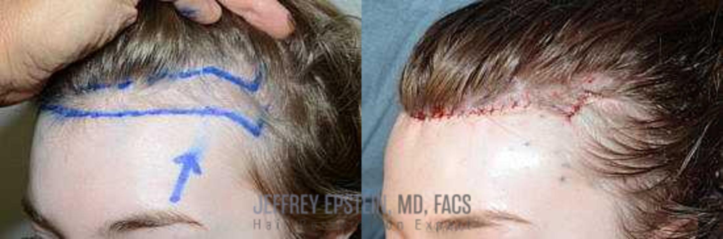 Before & After Hairline Lowering / Forehead Reduction Case 287 View 2 View in Miami, FL
