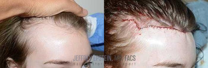 Before & After Hairline Lowering / Forehead Reduction Case 287 View 3 View in Miami, FL