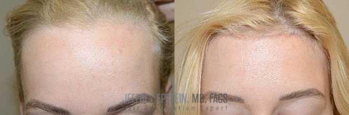 Before & After Hairline Lowering / Forehead Reduction Case 288 View 2 View in Miami, FL