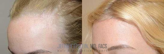 Before & After Hairline Lowering / Forehead Reduction Case 288 View 3 View in Miami, FL