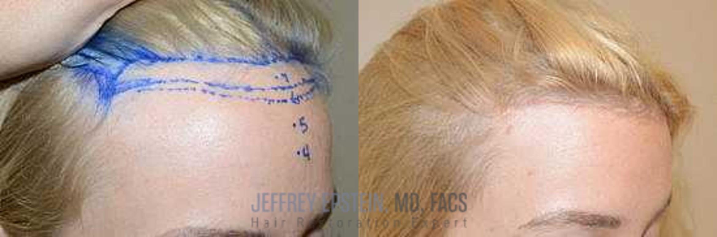 Before & After Hairline Lowering / Forehead Reduction Case 288 View 4 View in Miami, FL