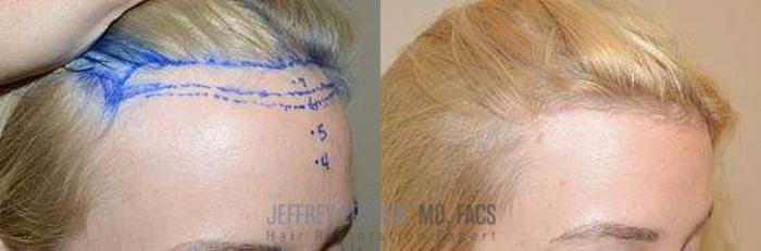 Before & After Hairline Lowering / Forehead Reduction Case 288 View 4 View in Miami, FL