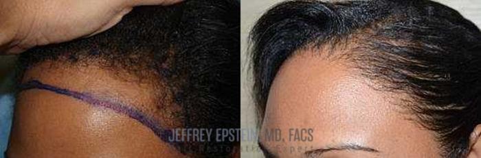 Before & After Hairline Lowering / Forehead Reduction Case 290 View 1 View in Miami, FL