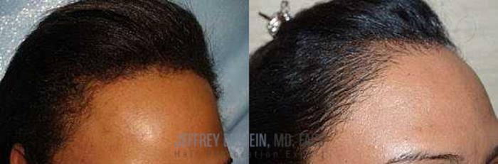 Before & After Hairline Lowering / Forehead Reduction Case 290 View 2 View in Miami, FL