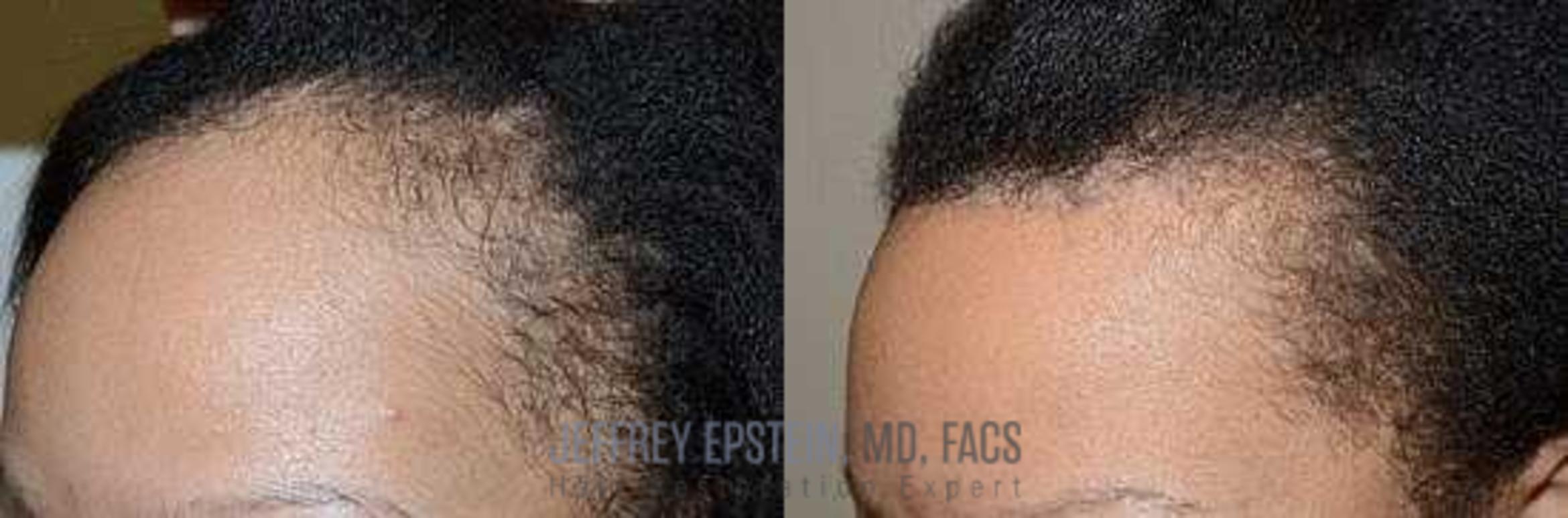 Before & After Hairline Lowering / Forehead Reduction Case 292 View 2 View in Miami, FL