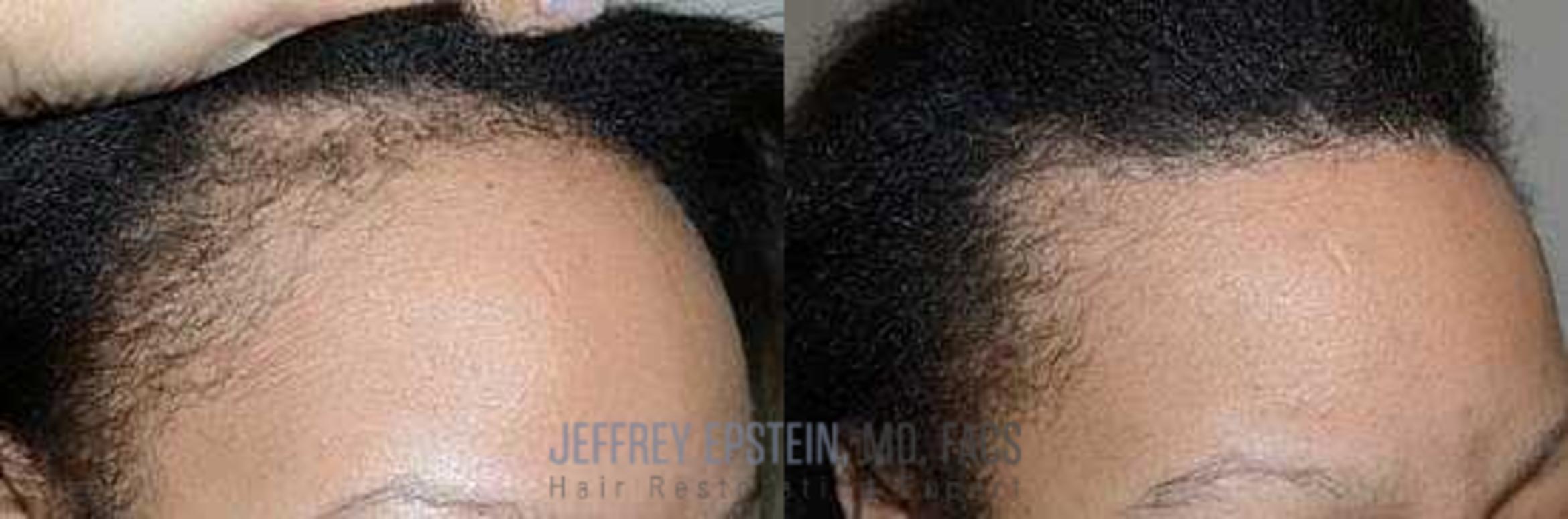 Before & After Hairline Lowering / Forehead Reduction Case 295 View 2 View in Miami, FL