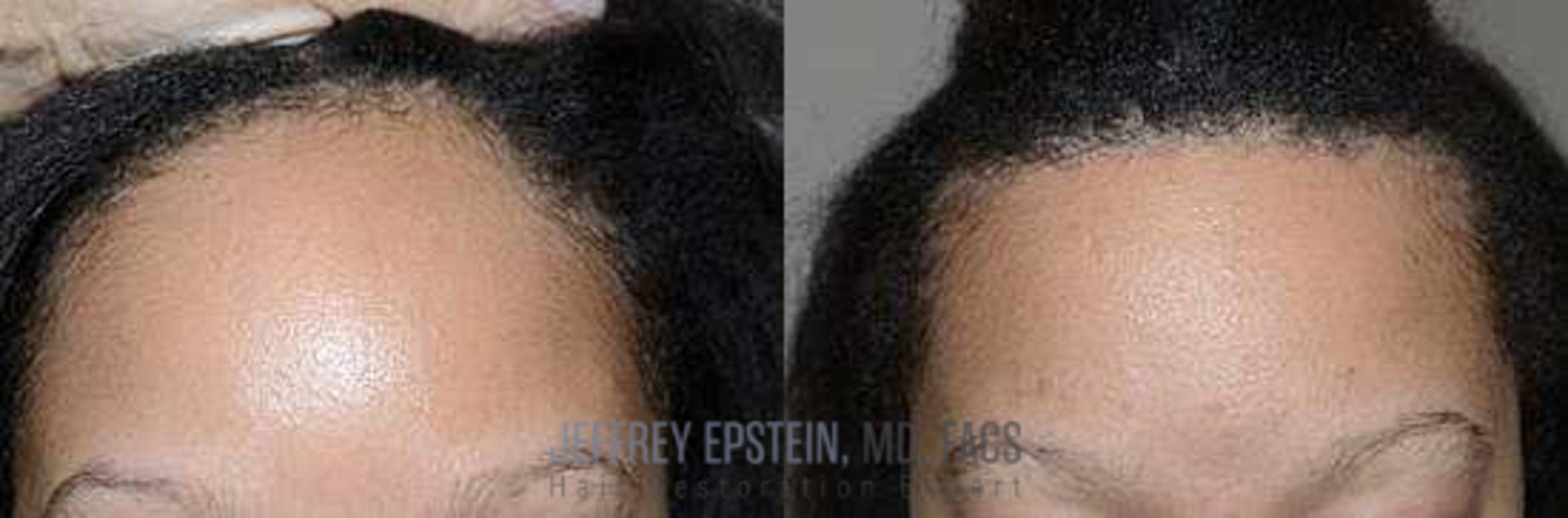 Before & After Hairline Lowering / Forehead Reduction Case 295 View 3 View in Miami, FL