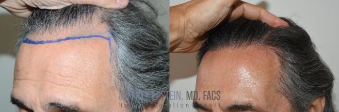 Before & After Hairline Lowering / Forehead Reduction Case 344 Left Side View in Miami, FL