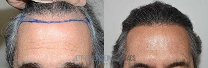 Before & After Hairline Lowering / Forehead Reduction Case 344 View 1 View in Miami, FL
