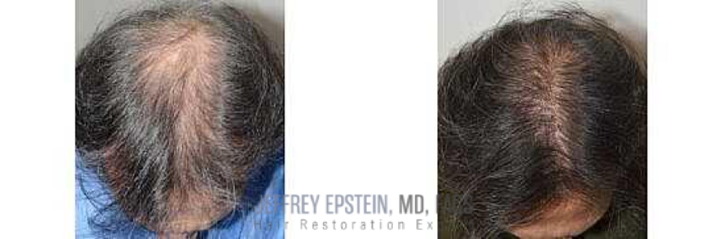 Before & After Hairline Lowering / Forehead Reduction Case 344 View 2 View in Miami, FL