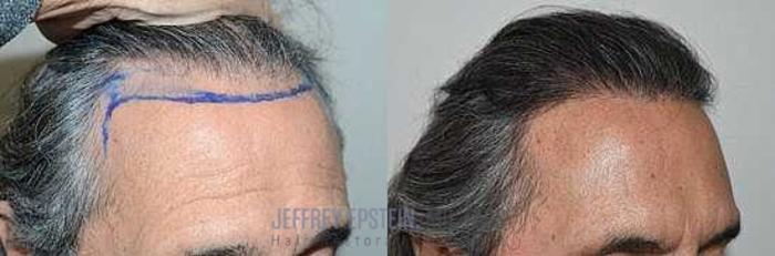 Before & After Hairline Lowering / Forehead Reduction Case 344 View 3 View in Miami, FL