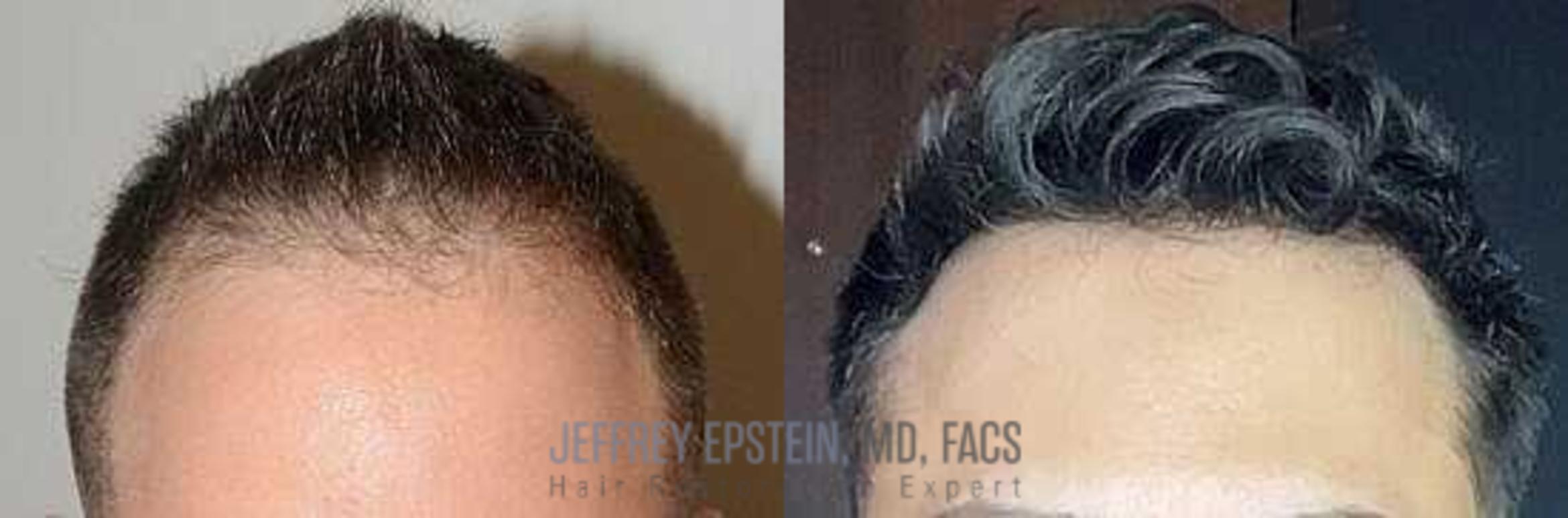 Before & After Hairline Lowering / Forehead Reduction Case 8 View 1 View in Miami, FL
