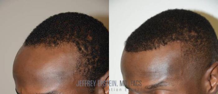 Before & After Hairline Lowering / Forehead Reduction Case 96 View 1 View in Miami, FL